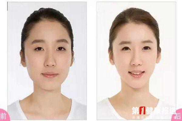 瘦脸 脸瘦 关键看整形技术