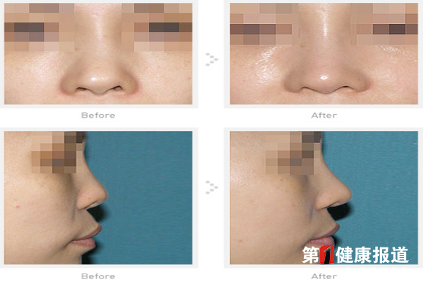 隆鼻失败后也可以追求二次美丽