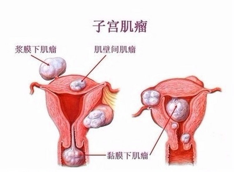 39岁女子病案分析，中西医如何治？