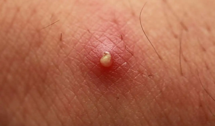 身上突然长的这种小黑点，到底是什么？能不能挤啊？！