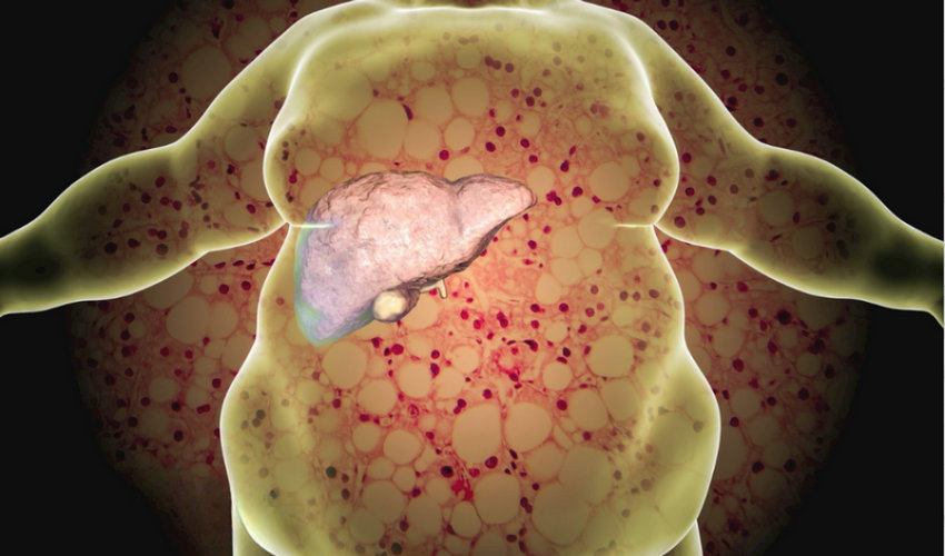 肝苏颗粒辅助脂肪肝治疗显成效​